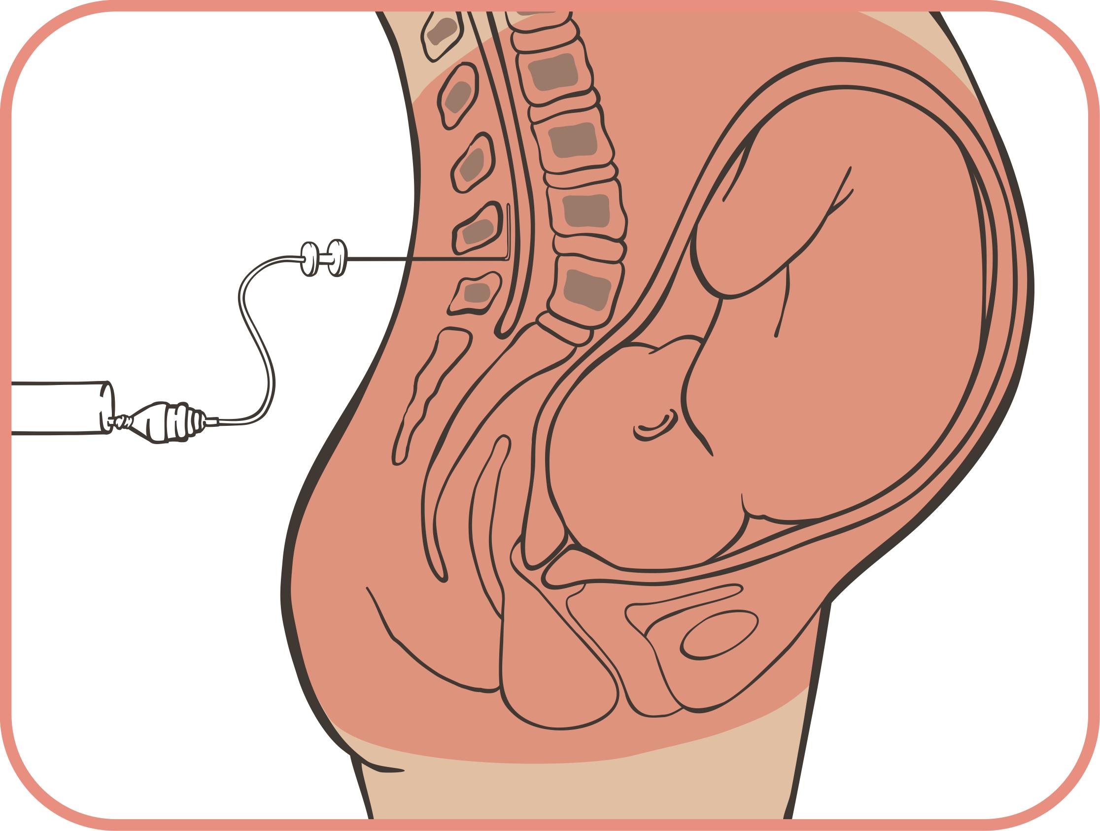 EPIDURAL PARTO