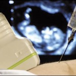 ¿Cómo se realiza una amniocentesis?